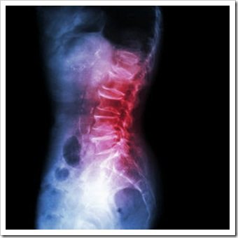 Back Pain Lakewood CO Arthritis