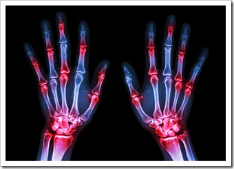 Rheumatoid Arthritis Solutions Lakewood CO