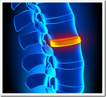 Herniated Disc and Back Pain Lakewood CO