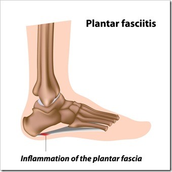 Foot Pain Lakewood CO Plantar Fasciitis