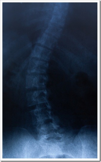 Scoliosis